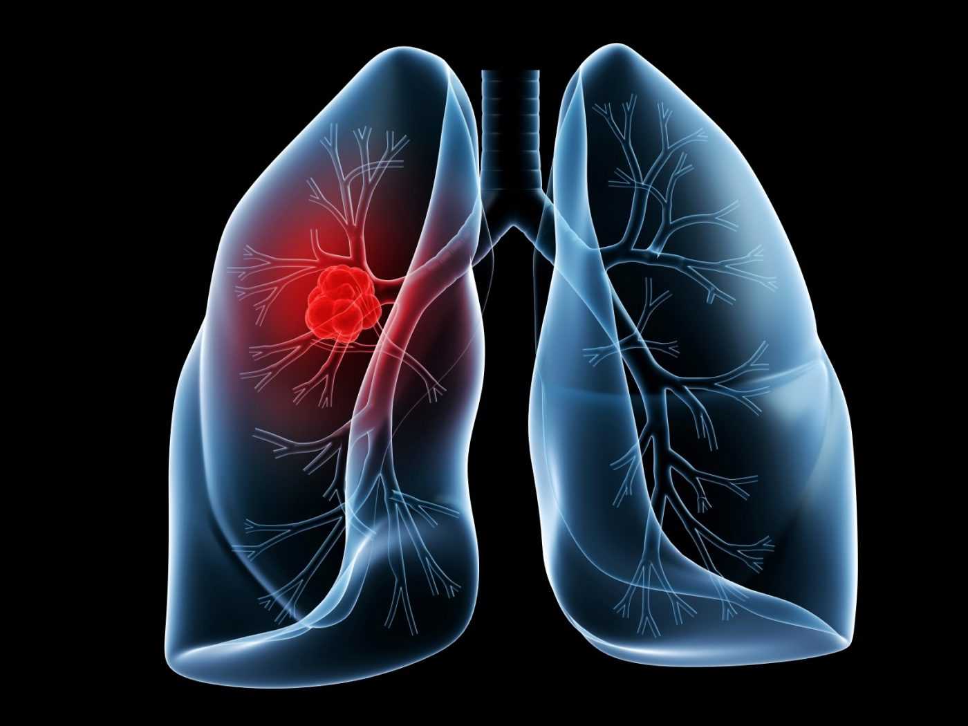 Pneumonia, Asthma, and Bronchitis