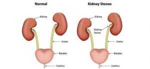 Facts About Kidney Stones