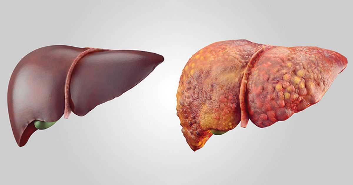 non alcoholic fatty liver disease treatment