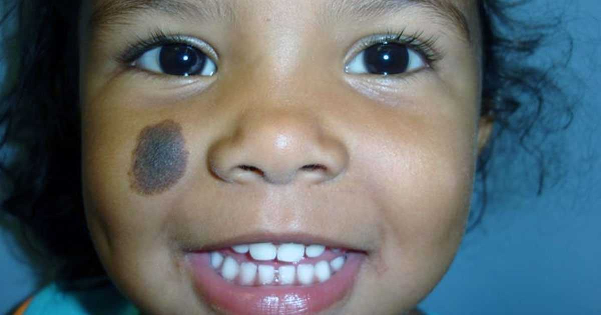 birth marks on face