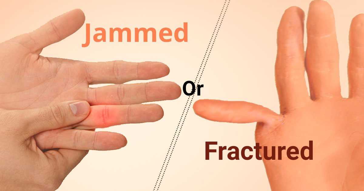 Jammed or Broken Finger? - Brandon P. Donnelly, MD