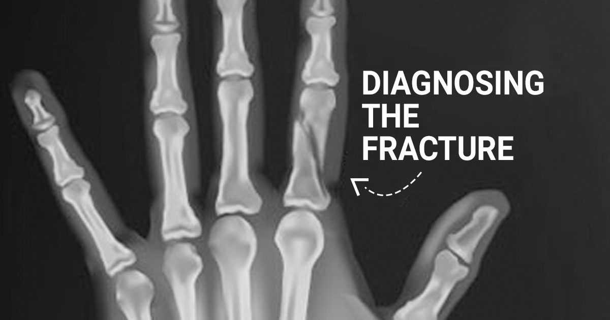 diagnosis of a fracture