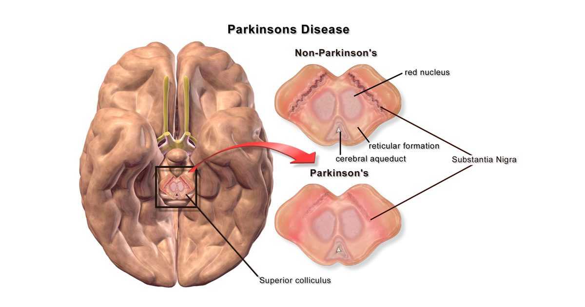 Brain changes in Parkinson's disease
