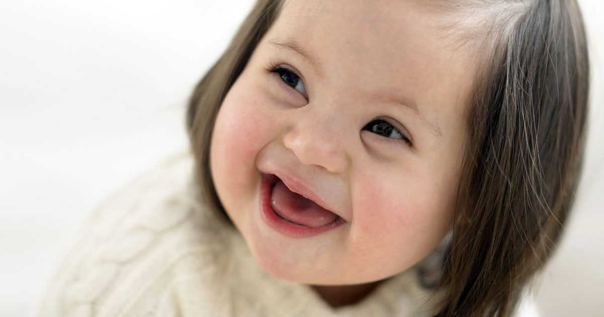 physical abnormaliites in down's syndrome