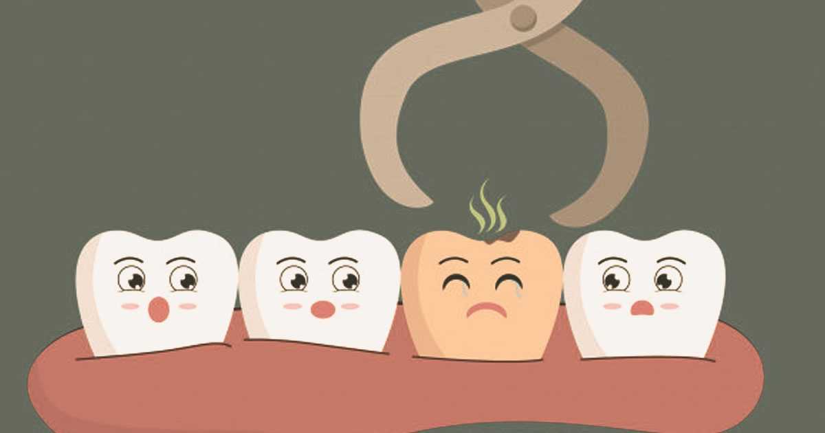 surgical extraction of wisdom tooth
