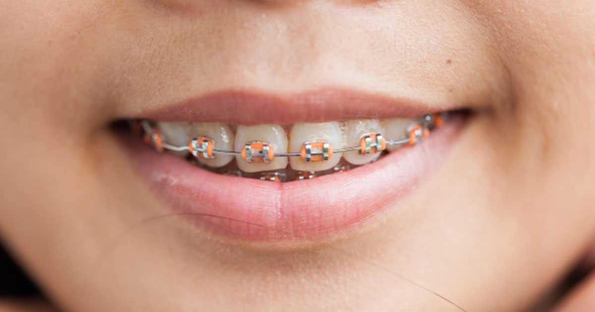 caring for braces
