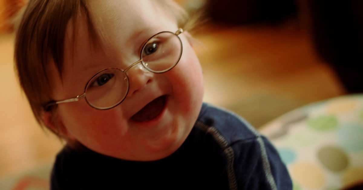 down's syndrome causes