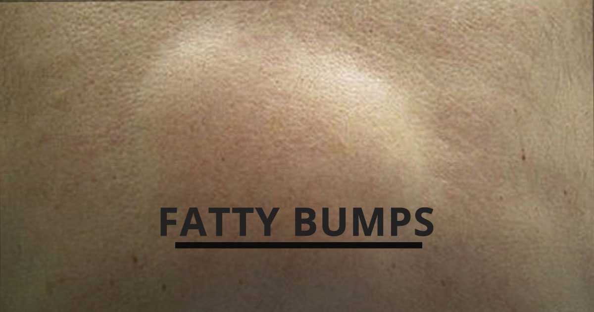 fatty bumps on skin