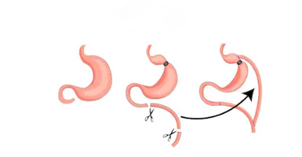Gastric sleeve surgery 