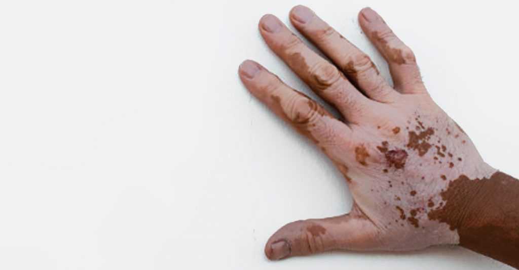 World vitiligo day 