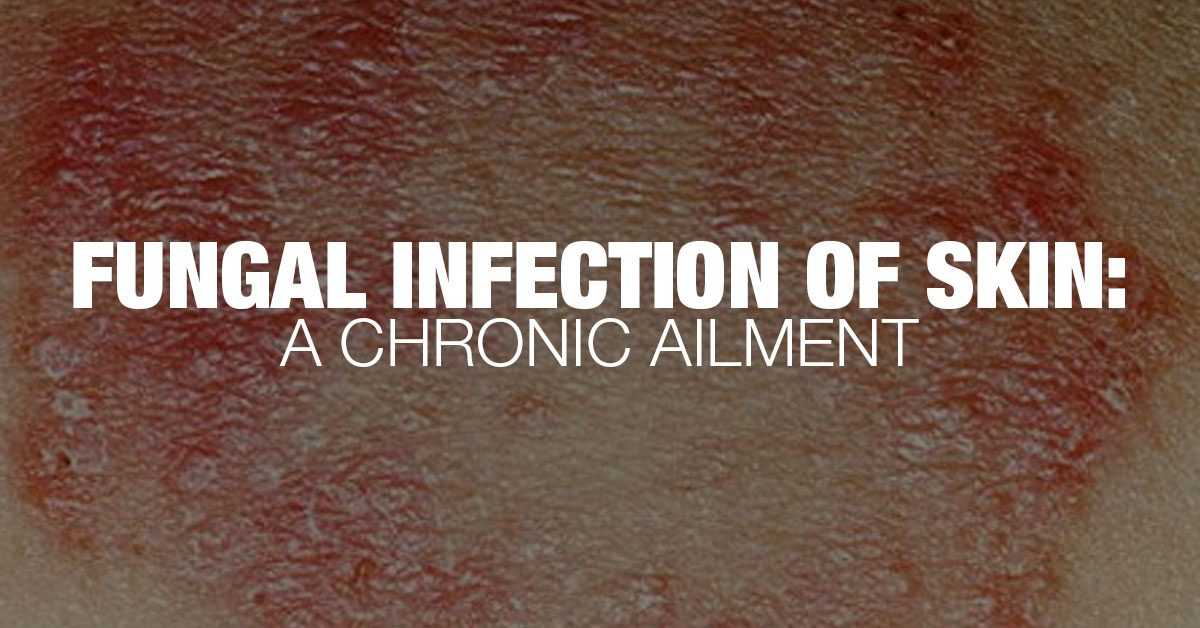 What Are Fungal Infections Of The Skin Know The Facts