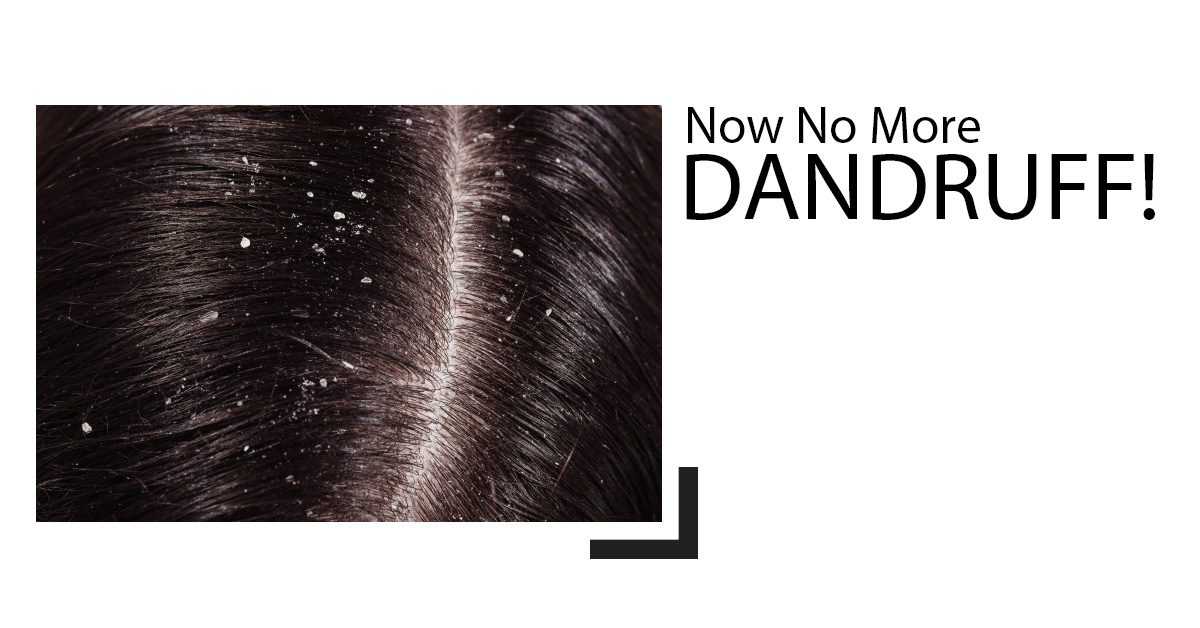 How To Get Rid Of Dandruff On Your Scalp?- 9 easy Remedies! | Marham