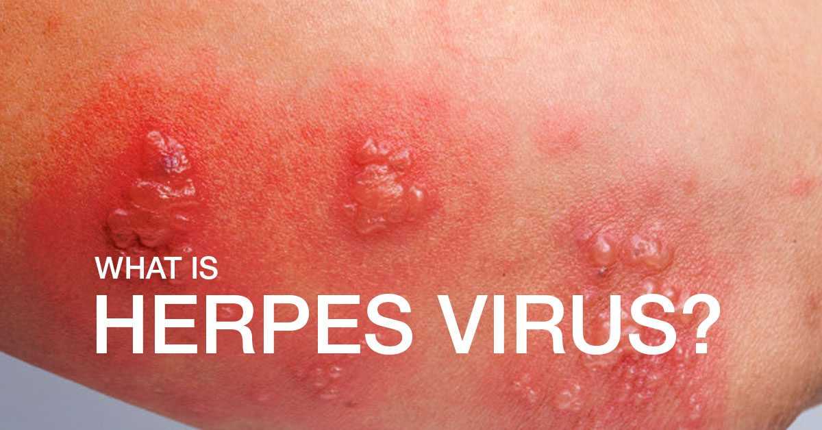 What is a herpes virus