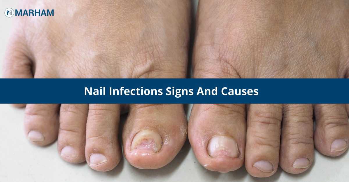 🥇 Signs of a Fungal Nail Infection - Olansky Dermatology & Aesthetics