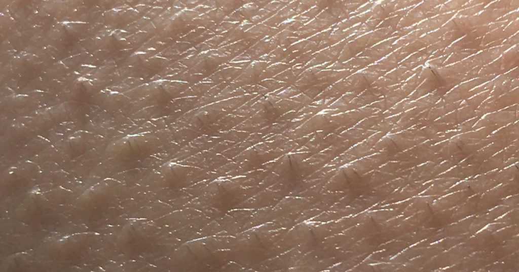 How to Remove Chicken Skin under Armpit Naturally