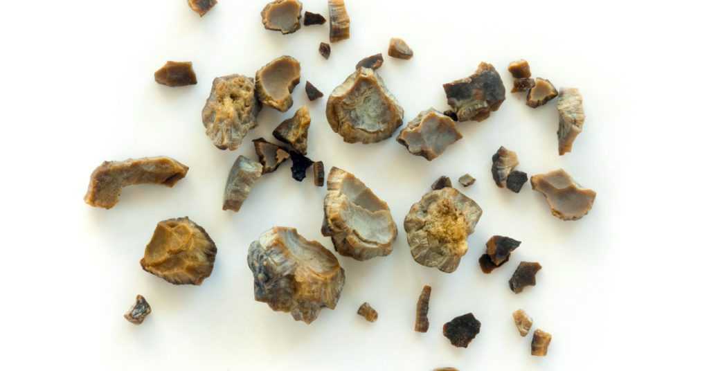 Kidney Stone Causes in Pakistan