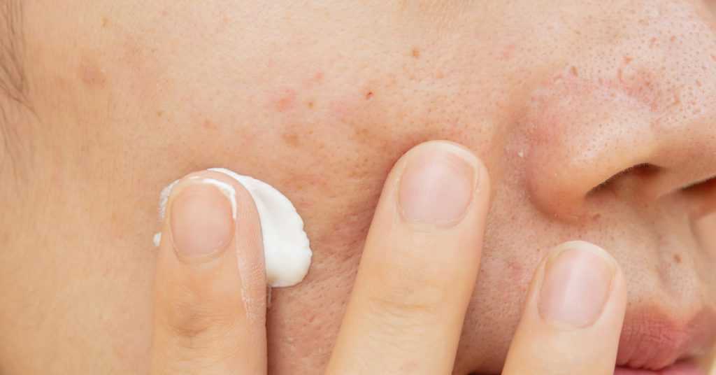 Skin Whitening Creams in Pakistan