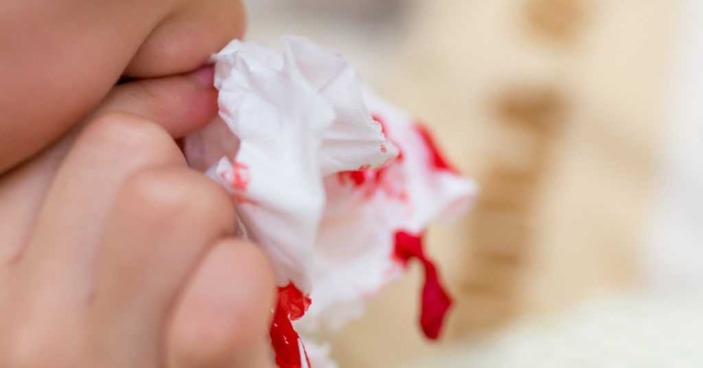 nose bleeding in children