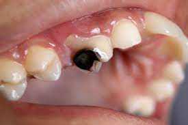دانتوں میں کیڑا لگنے کی وجوہات