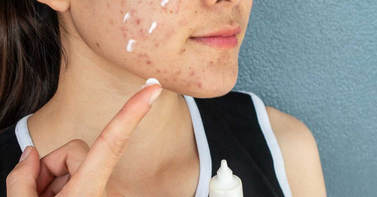 Best Skin Care Routine for Hormonal Acne
