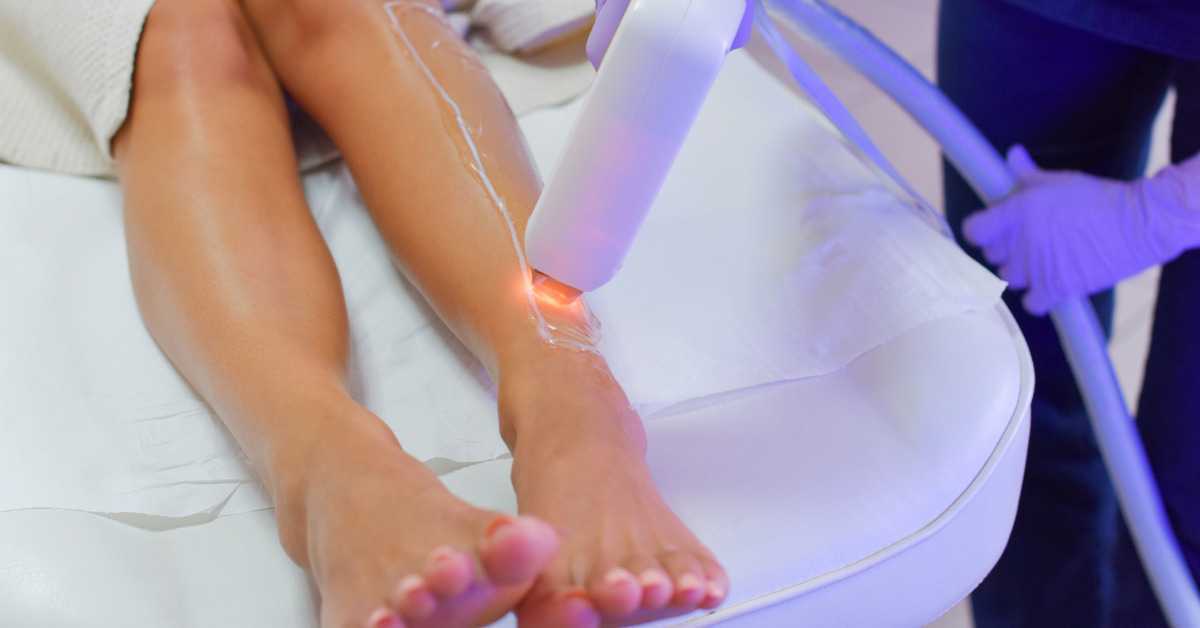  5 Benefits of Laser Hair Removal