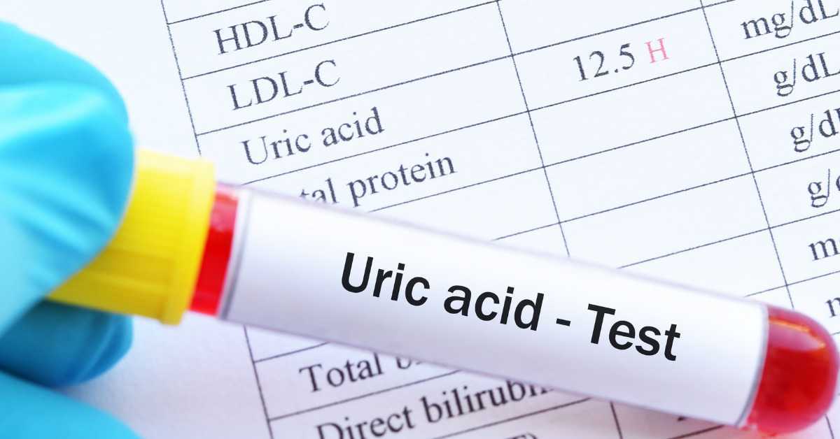 High Uric Acid LeveL