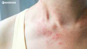 Eczema Treatment In Pakistan