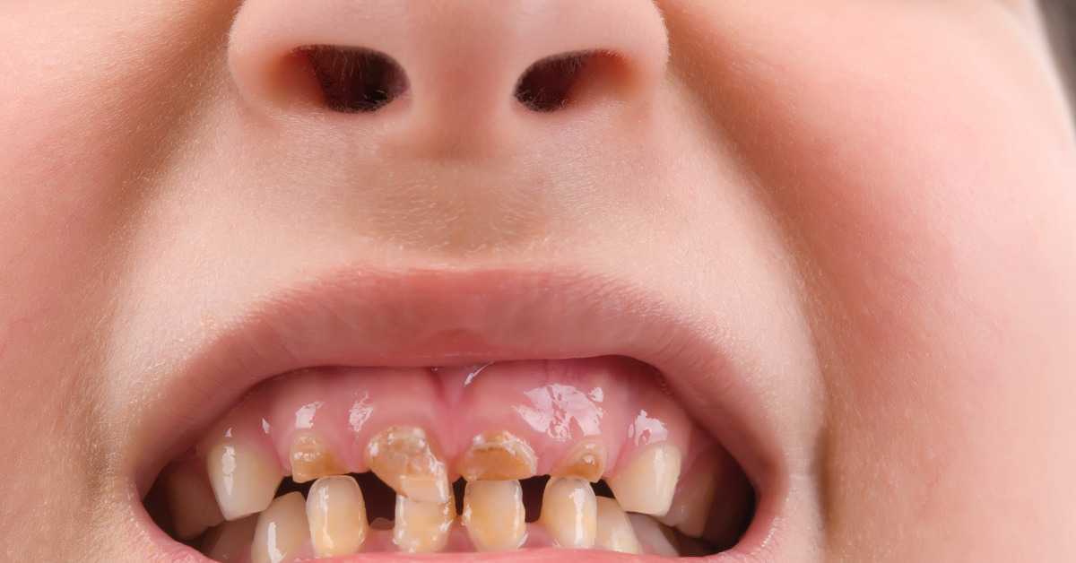 Common Dental Issues