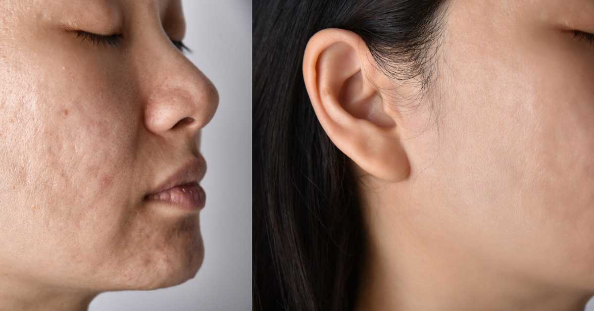 Acne Treatment for Asian Skin