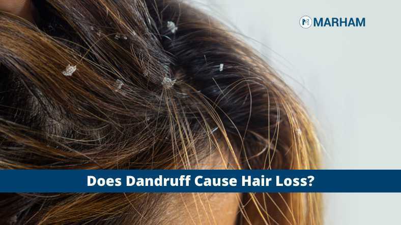 Does Dandruff Cause Hair Loss? | Marham