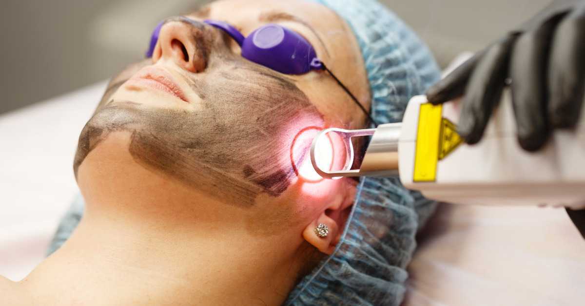 Laser Carbon Skin Treatment