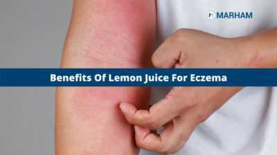 lemon juice for eczema