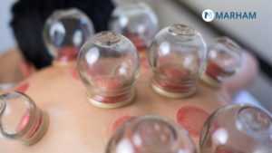 Benefits Of Cupping For Weight Loss