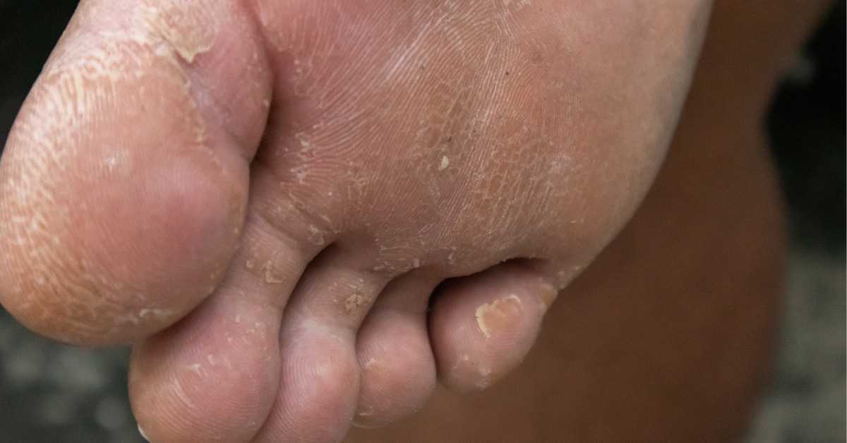How to Get Dead Skin off Feet