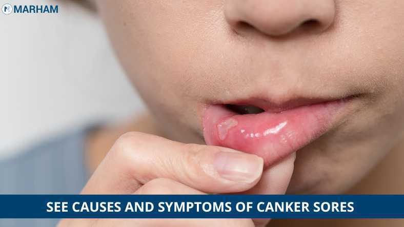 Canker Sores On Lips Symptoms Causes And Treatment Marham