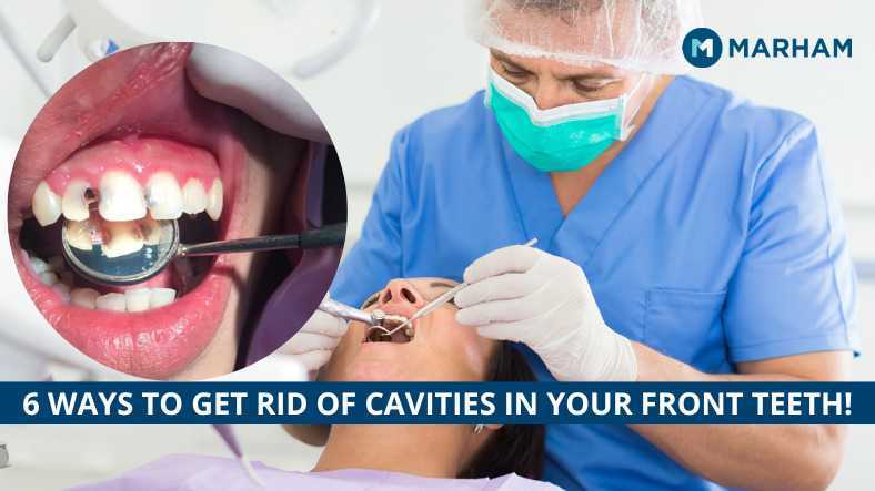 how to treat a cavity on front tooth