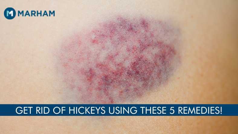 How To Get Rid Of Hickeys Overnight 5 Fast Solutions Marham