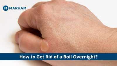 How to Get Rid of a Boil Overnight