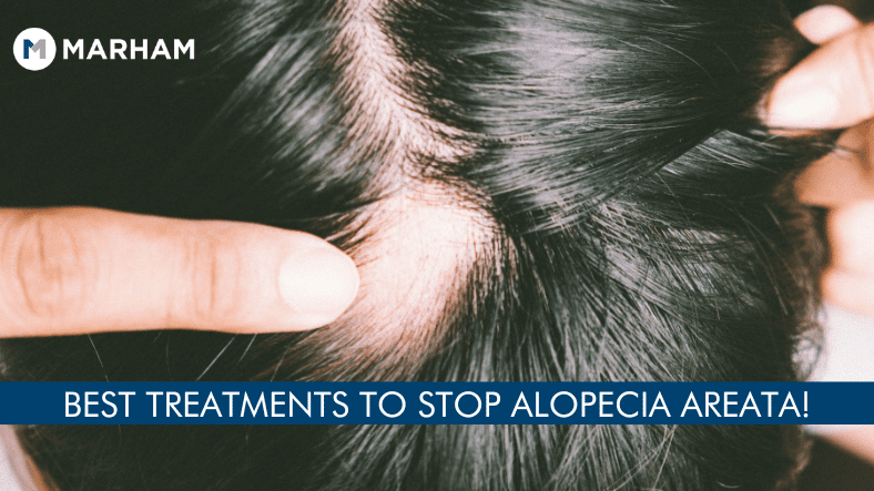 How to Stop Alopecia Areata from Spreading? | Marham