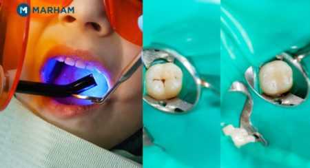 How long does it take to Fill a Cavity