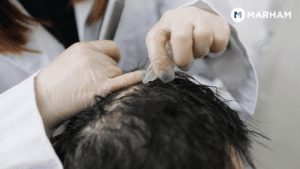 Hair Transplants and Treatments