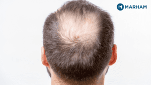 Hair loss in males