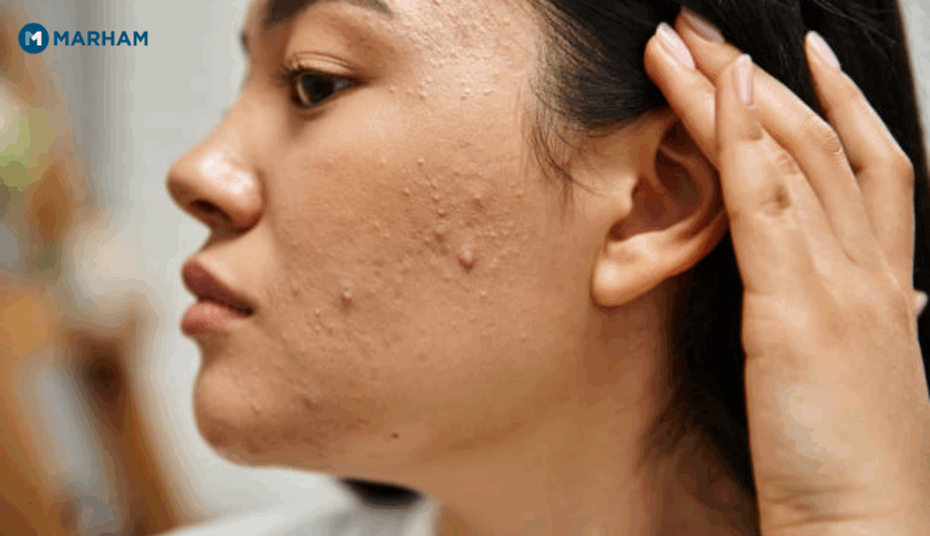 Acne Treatment in Pakistan: Causes, Symptoms & How to Get Rid of It Acne Treatment in Pakistan