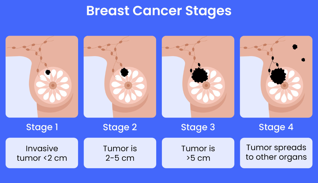 Breast Cancer Stages