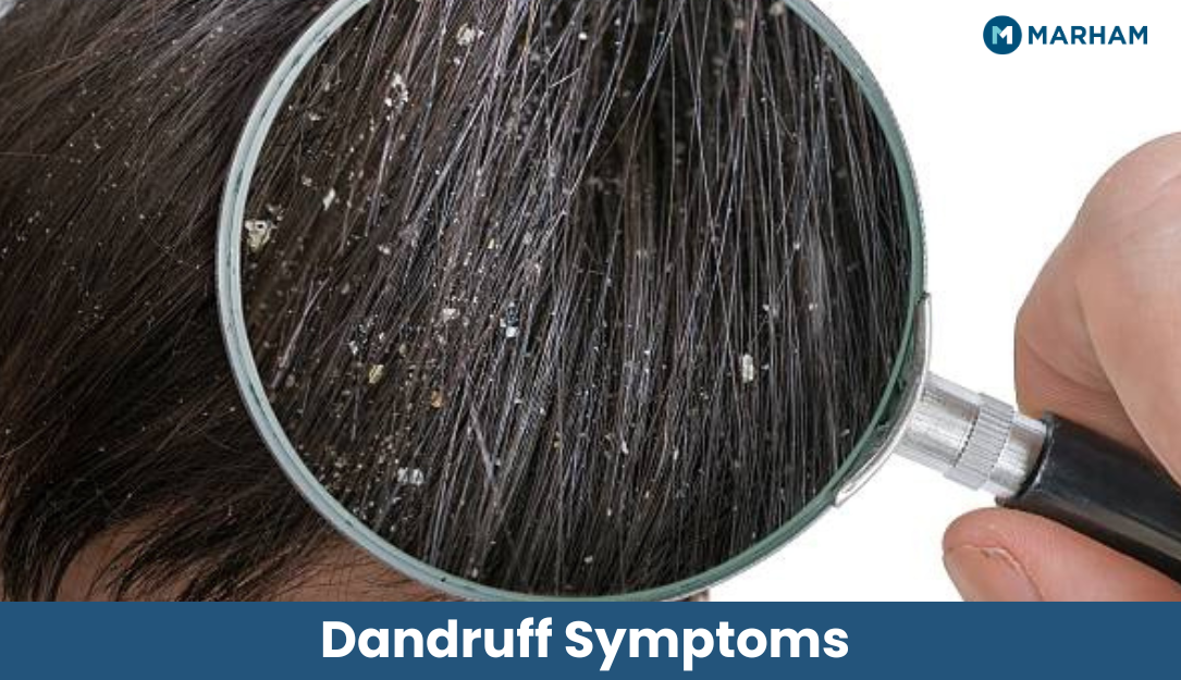 Dandruff Symptoms