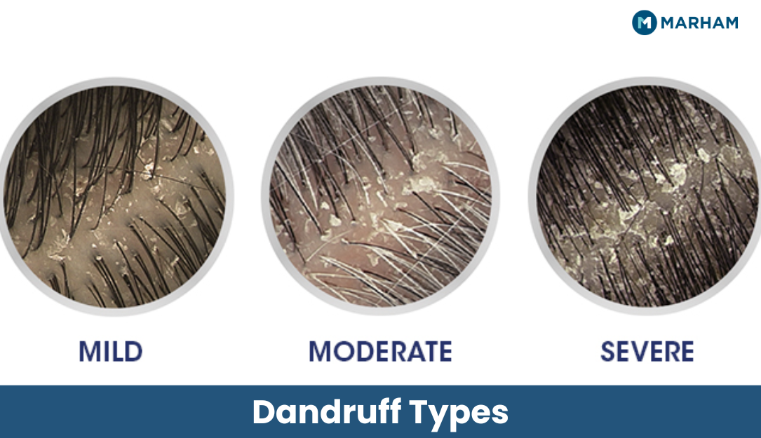Dandruff Types