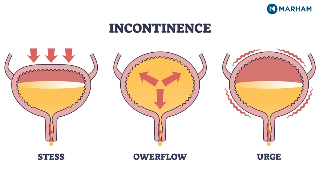 Urinary Incontinence Types