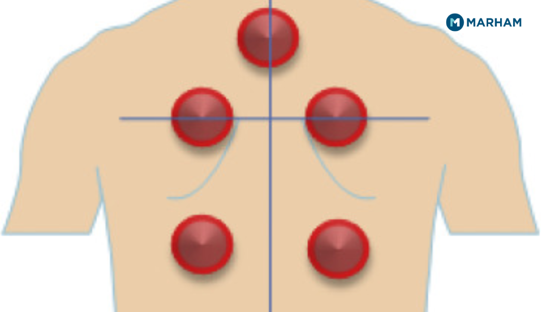 Hijama Points