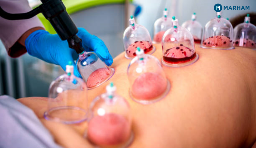 Hijama Therapy
