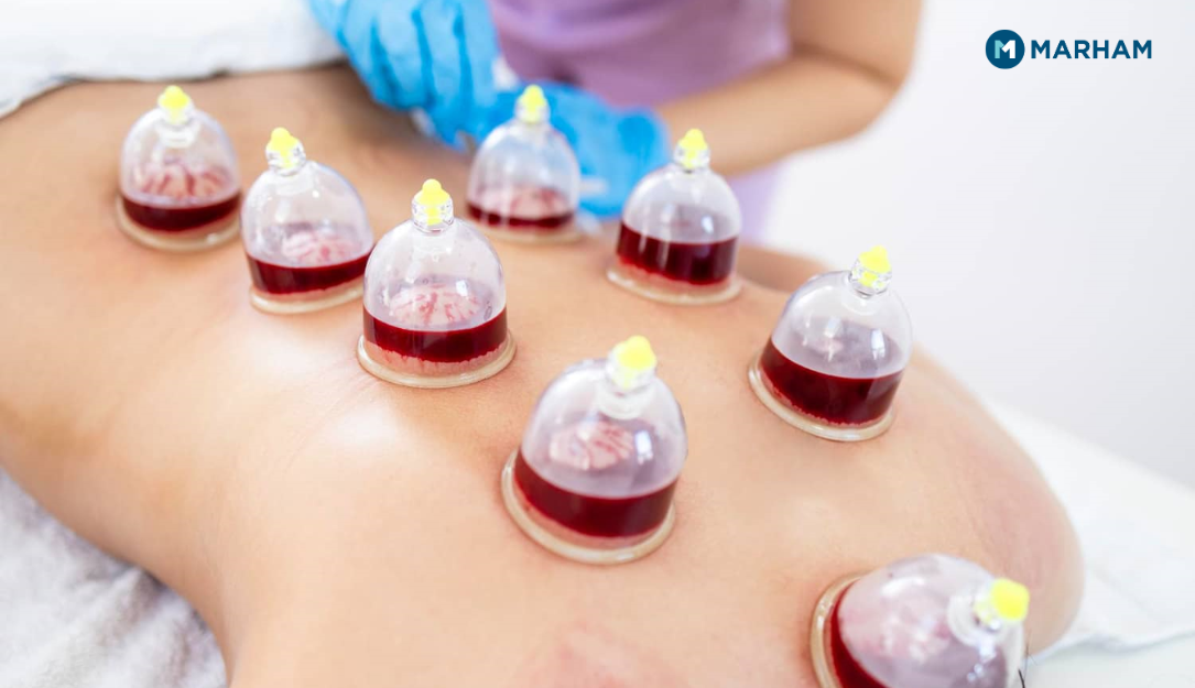 Wet Cupping Therapy
